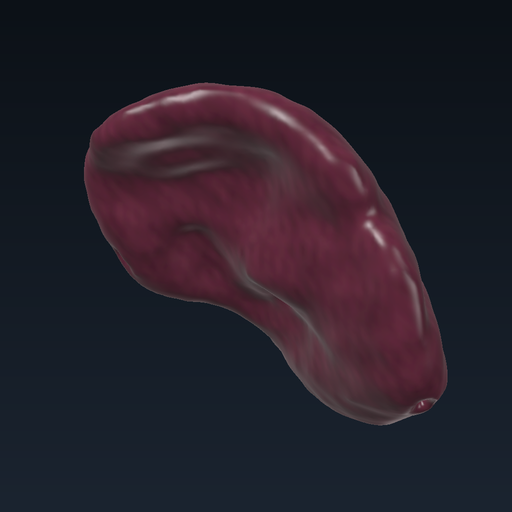 Splenomegali
