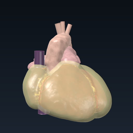 Pericardial effusion