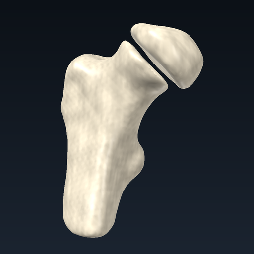 Femoral neck fracture